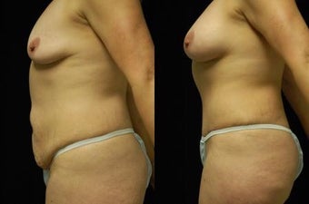 Tummy Tuck and Breast Augmentation, gel implants