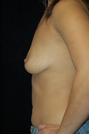 Breast Augmentation, gel implants