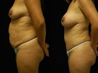 Tummy Tuck and Breast Augmentation