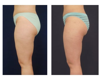 Liposuction
