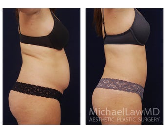 Liposuction