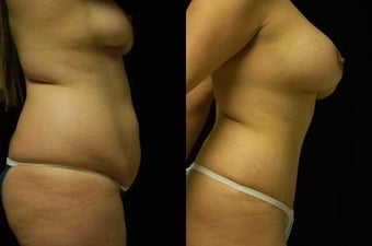 Tummy Tuck and Breast Augmentation- gel implants