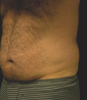 Liposucction of the Abdomen and Waist using Smart Lipo MPX