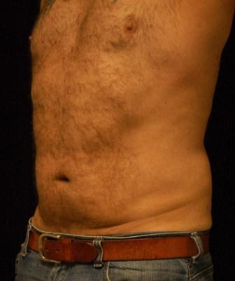 Liposucction of the Abdomen and Waist using Smart Lipo MPX
