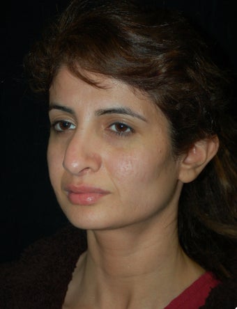 Revision Rhinoplasty