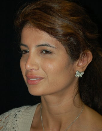 Revision Rhinoplasty