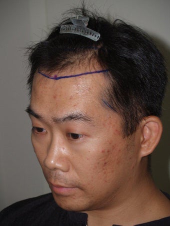 Hair Transplant 