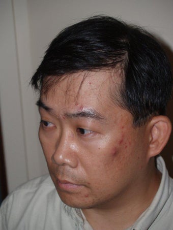 Hair Transplant 