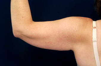 Liposuction - Upper Arms