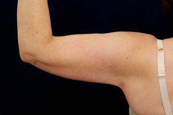 Liposuction - Upper Arms