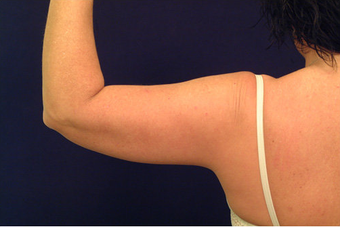 Liposuction