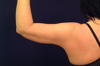 Liposuction