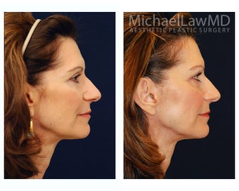 Facial Rejuvenation