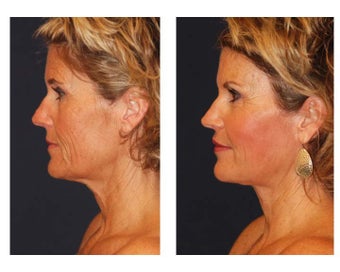 Facial Rejuvenation
