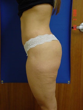 Brazilian Butt Lift/Liposuction