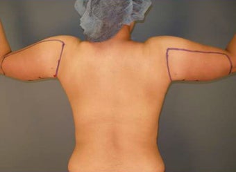 Tumescent Liposuction Under Local Anesthesia.