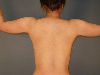 Tumescent Liposuction Under Local Anesthesia.