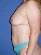 Breast Augmentation, Tummy Tuck (Abdominoplasty), Mommy Makeover