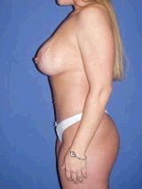 Breast Augmentation, Tummy Tuck (Abdominoplasty), Mommy Makeover