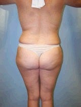 Tummy Tuck (Abdominoplasty), Breast Augmentation, Mommy Makeover