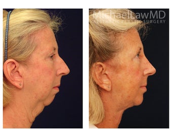 Facial Rejuvenation