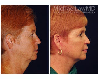 Facial Rejuvenation