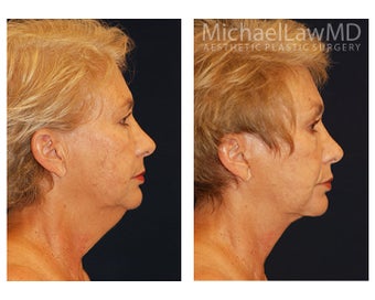 Facial Rejuvenation