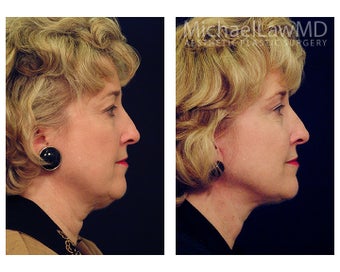 Facial Rejuvenation - Neck Lift