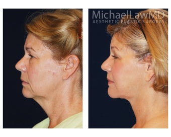 Facial Rejuvenation - Neck Lift