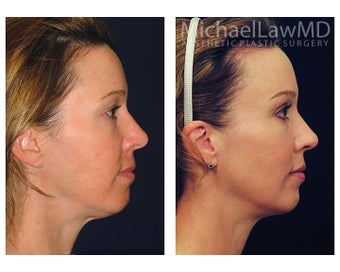 Chin Liposuction
