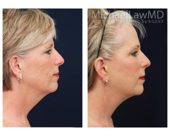 Facial Rejuvenation - Brow Lift