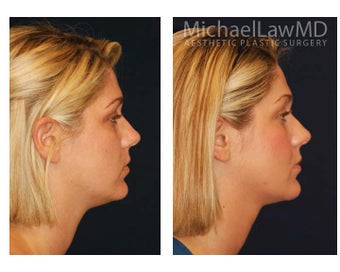 Chin Liposuction