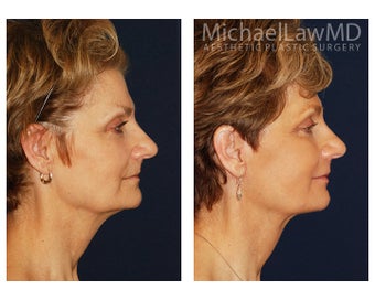 Facial Rejuvenation
