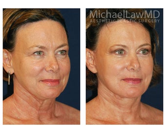 Facial Rejuvenation
