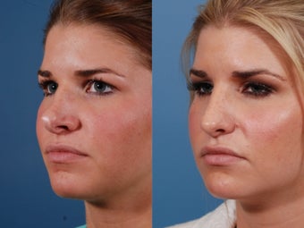 Revision rhinoplasty
