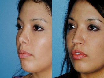 Revision rhinoplasty