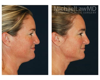 Chin Liposuction