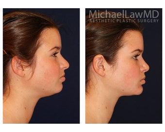 Chin Liposuction