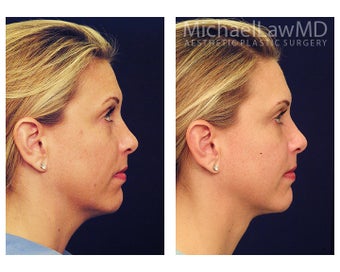 Chin Liposuction