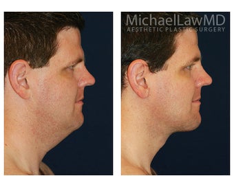 Lower Face and Neck Lift