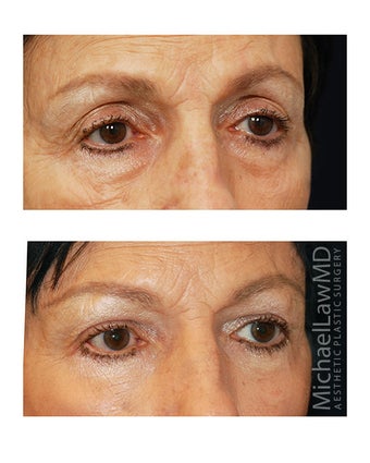 Facial Rejuvenation - Brow Lift