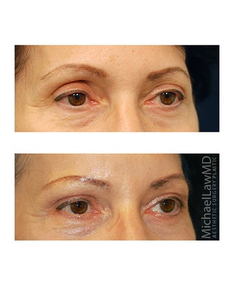 Facial Rejuvenation - Brow Lift