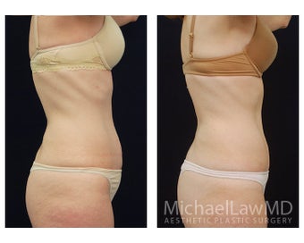Abdominoplasty - Tummy Tuck