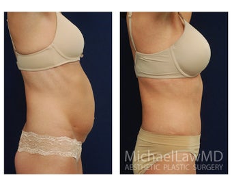 Abdominoplasty - Tummy Tuck