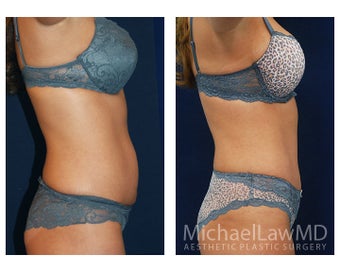 Abdominoplasty - Tummy Tuck