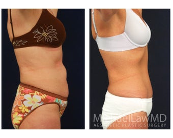 Abdominoplasty - Tummy Tuck