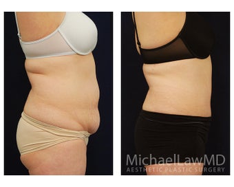 Abdominoplasty - Tummy Tuck