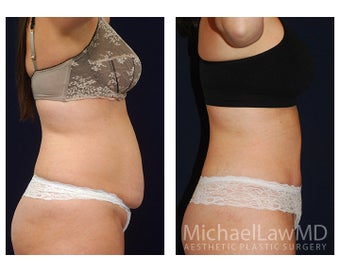 Abdominoplasty - Tummy Tuck