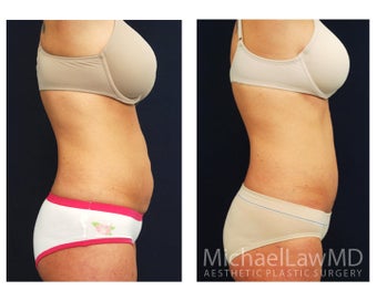 Abdominoplasty - Tummy Tuck