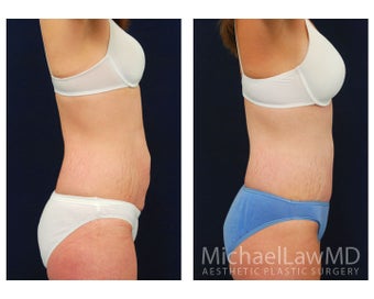 Abdominoplasty - Tummy Tuck
